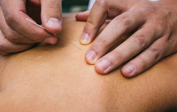 Client Receiving Acupuncture Services in Ottawa